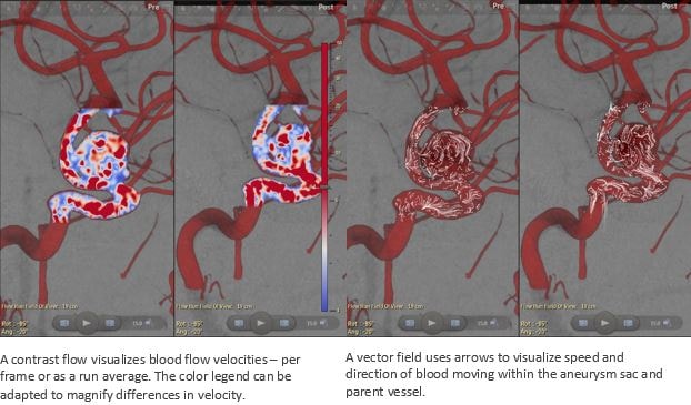 the contrast flow that visualizes blood flow velocities