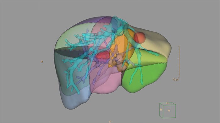 prostatitis számítógépes tomográfia Neurodoz a prosztatitisből