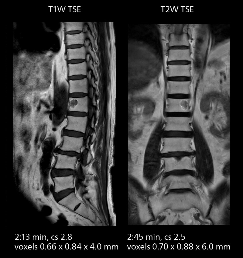 Lumbar spine mri two