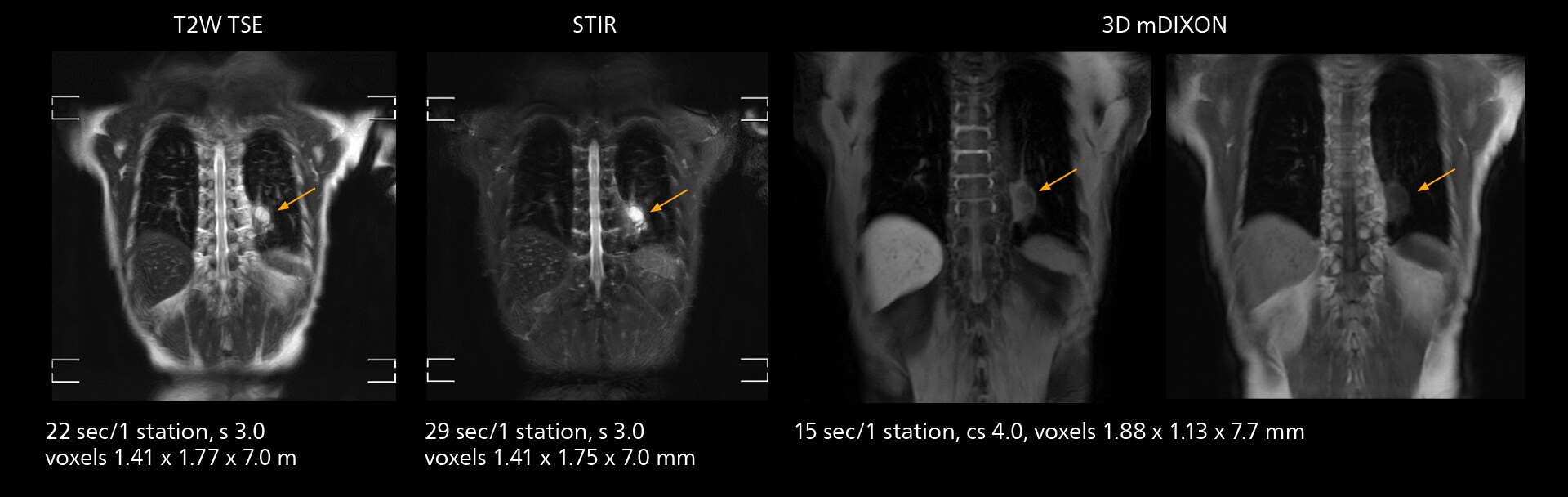 Whole body mri one