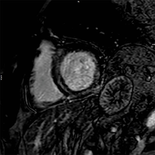 PSIR – short axis view 