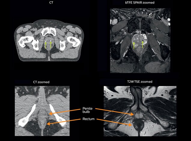 Prostatitis és emberi súly