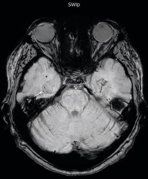 UVM case 1 SWIp hemosiderin foci in brain1