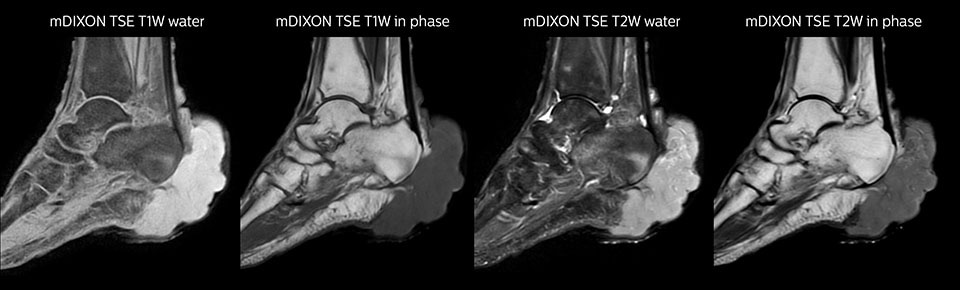 mDIXON TSE of ankle