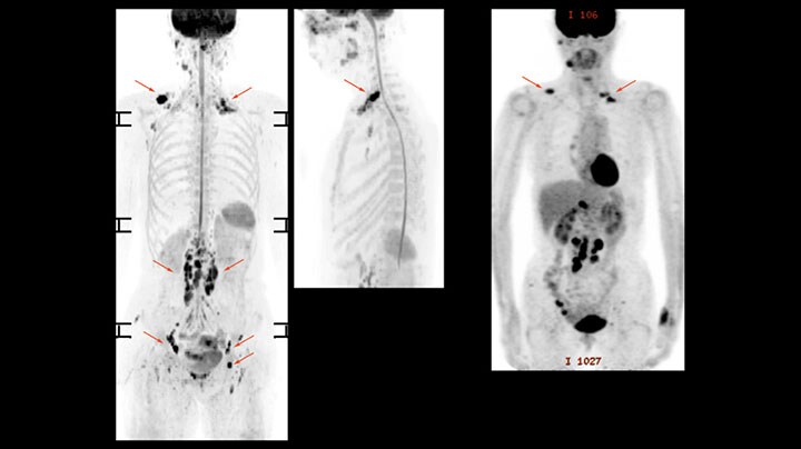 Whole body diffusion