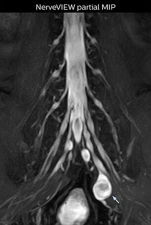 NerveVIEW partial MIP