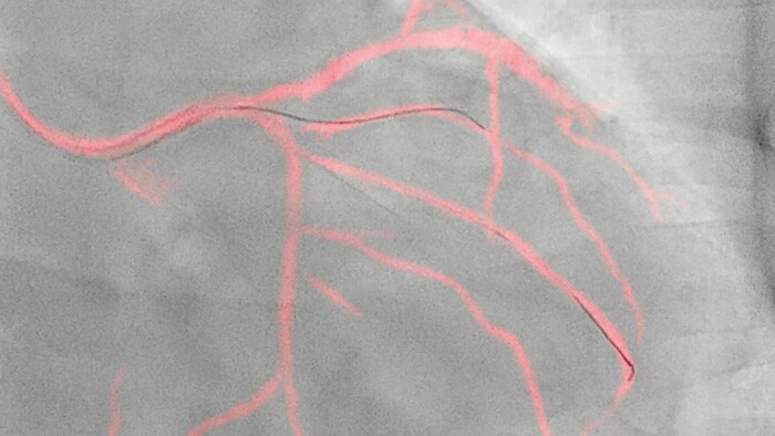 Dynamic coronary roadmap