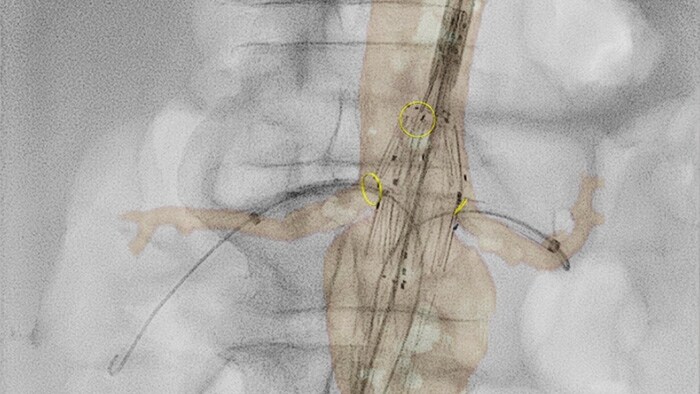 VesselNavigator CTA image fusion guidance