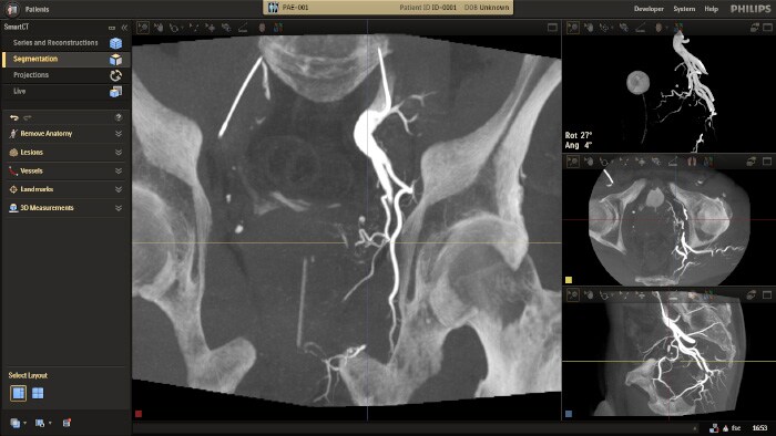 Prostate vasculature PAE SmartCT Soft Tissue procedure clinical image 