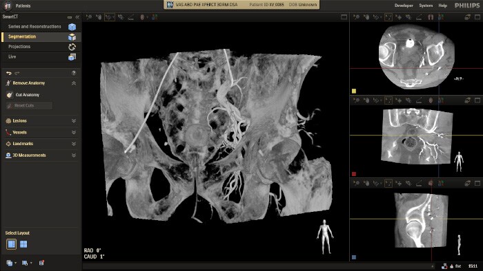 PAE clinical image