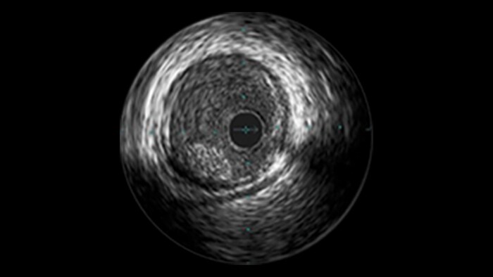 SVGS and Thrombus Lesions