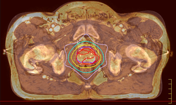 Számítógépes tomográfia prosztatitis