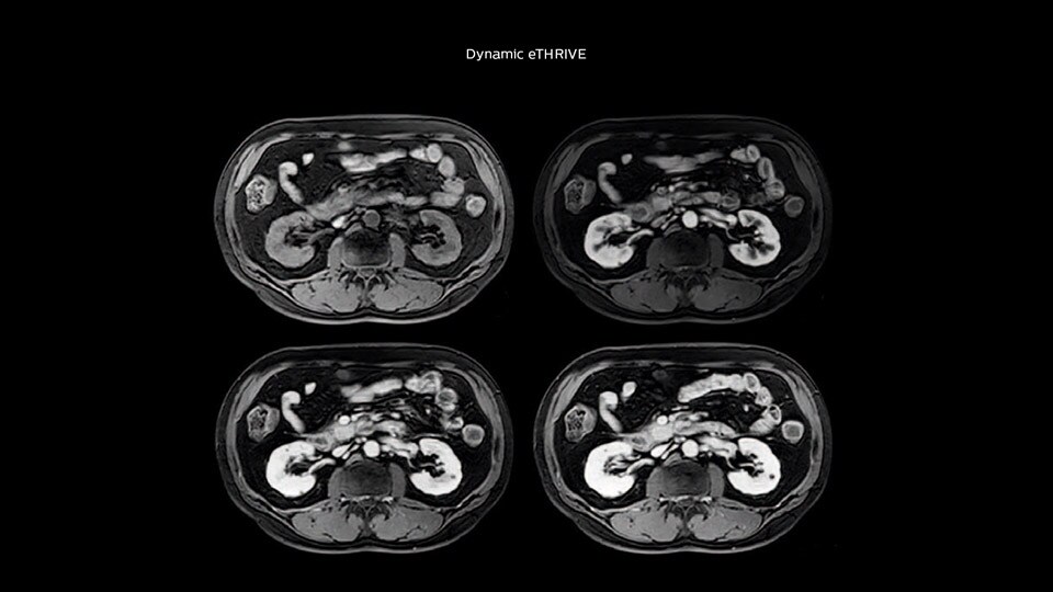 Bremen Case 3 Pancreas tumor 960px