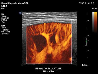 Renal Capsule MCPA