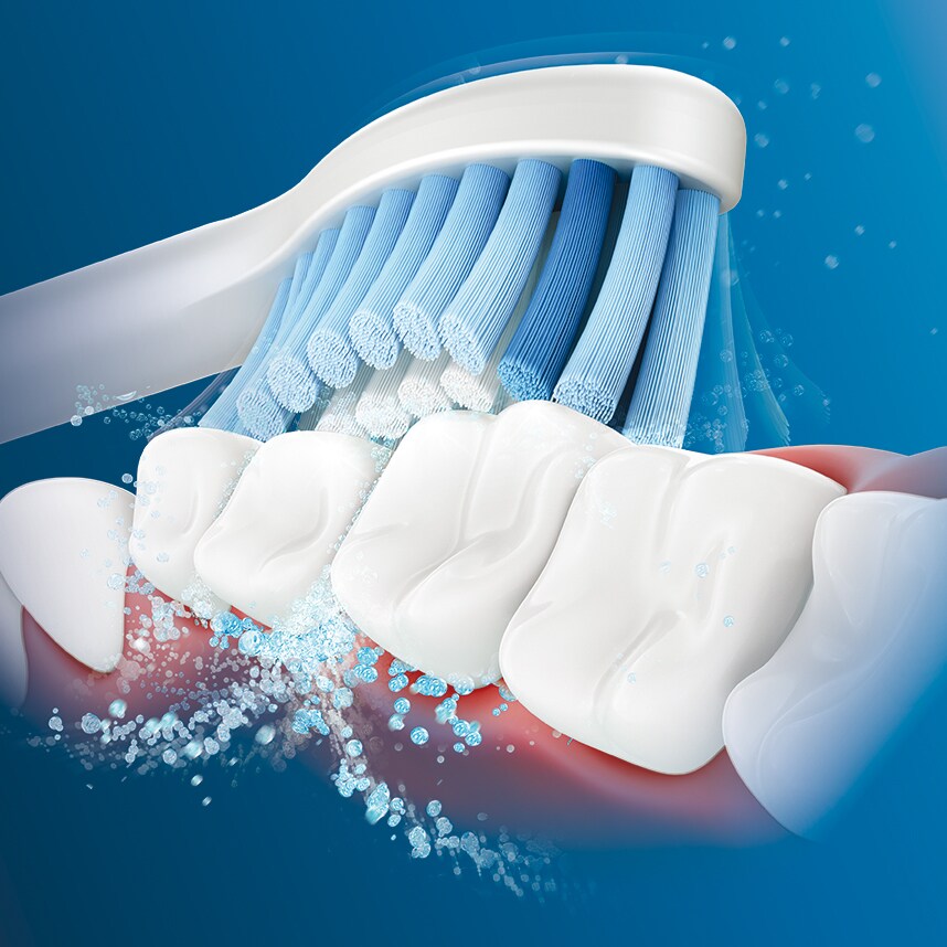 Evaluating the benefits of daily use of the Philips Sonicare Orthodontic Regimen